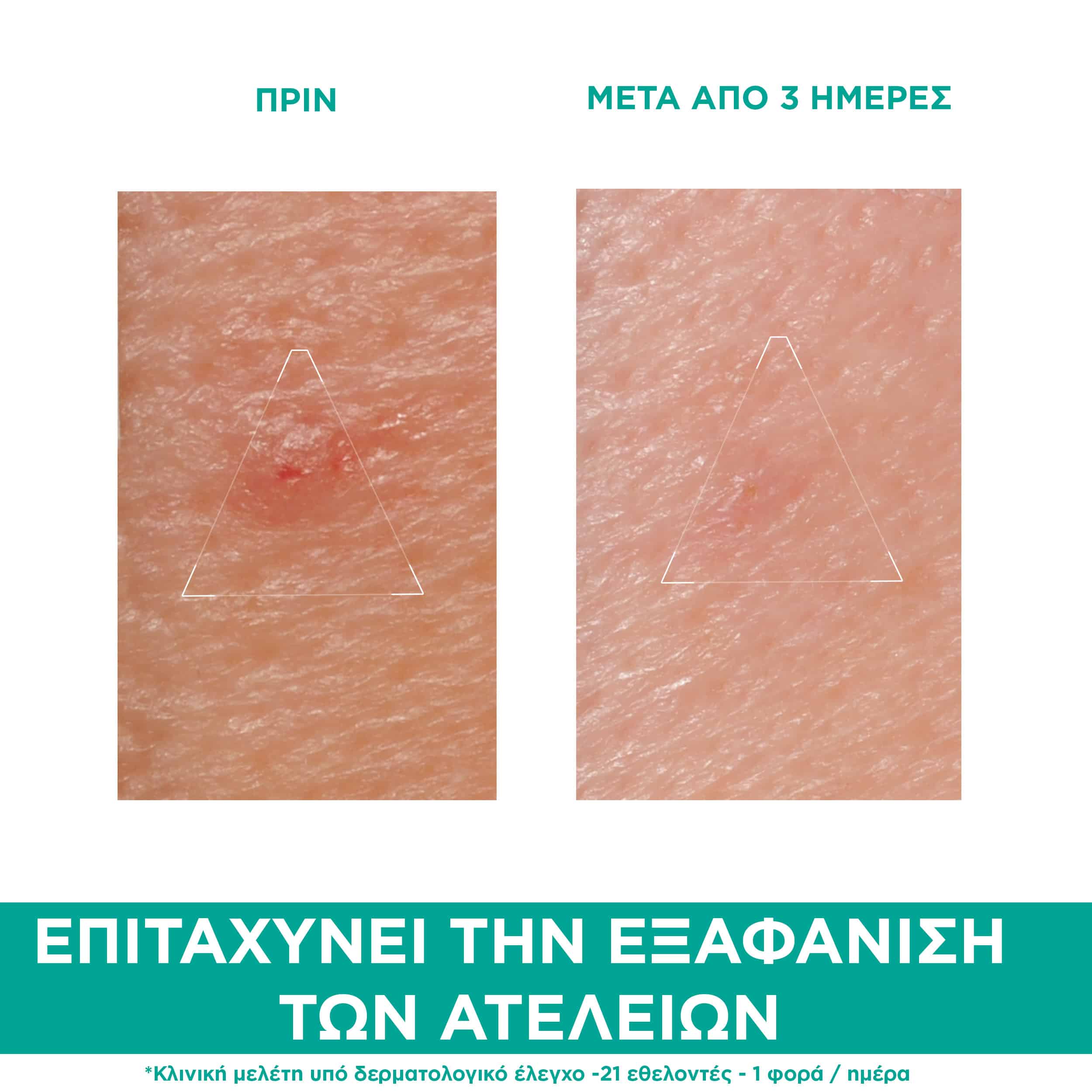 URIAGE - HYSEAC Pate SOS Soin Local - 15ml